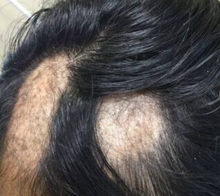 Patient Receives Treatment for Alopecia Areata | Case 105103