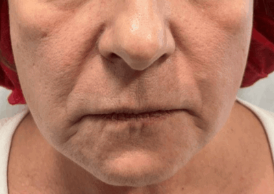 Patient Receives Dermal Fillers | Case 105102