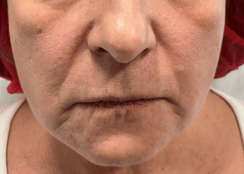 Patient Receives Dermal Fillers | Case 105102