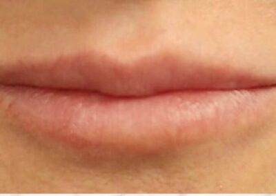 Patient Receives Dermal Fillers In Lips | Case 105101