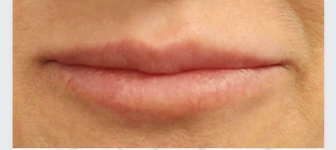 Patient Receives Dermal Fillers In Lips | Case 105101