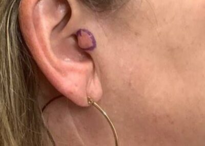Patient Receives Treatment for Skin Cancer | Case 105694