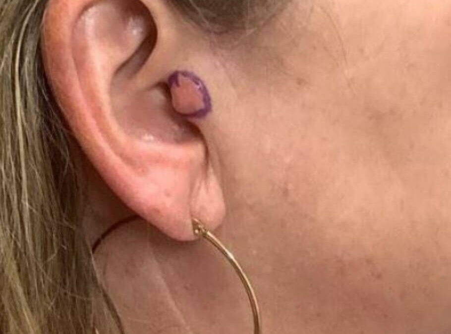 Patient Receives Treatment for Skin Cancer | Case 105694