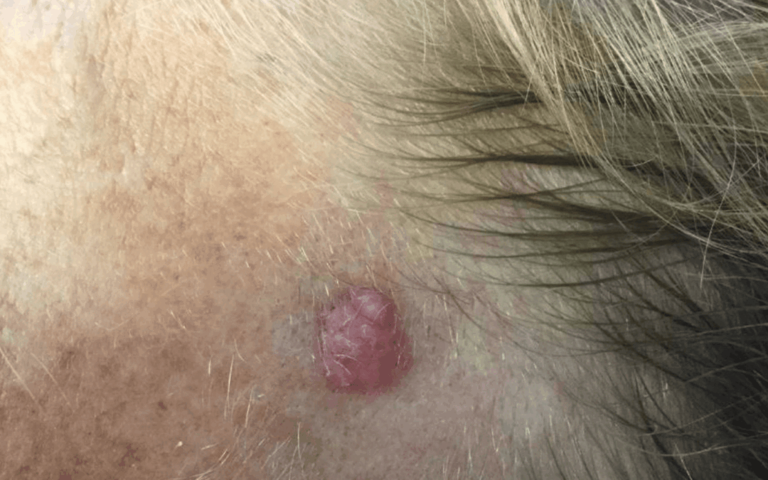 Patient Receives Skin Cancer Surgery | Case 105692