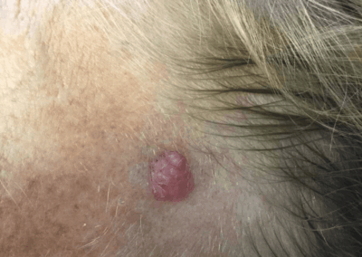 Patient Receives Skin Cancer Surgery | Case 105692